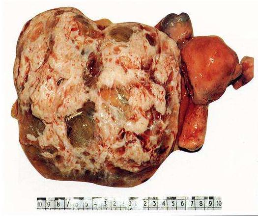 子宫肌瘤变性b超报告单会提示吗,查出子宫肌瘤囊性变怎么办