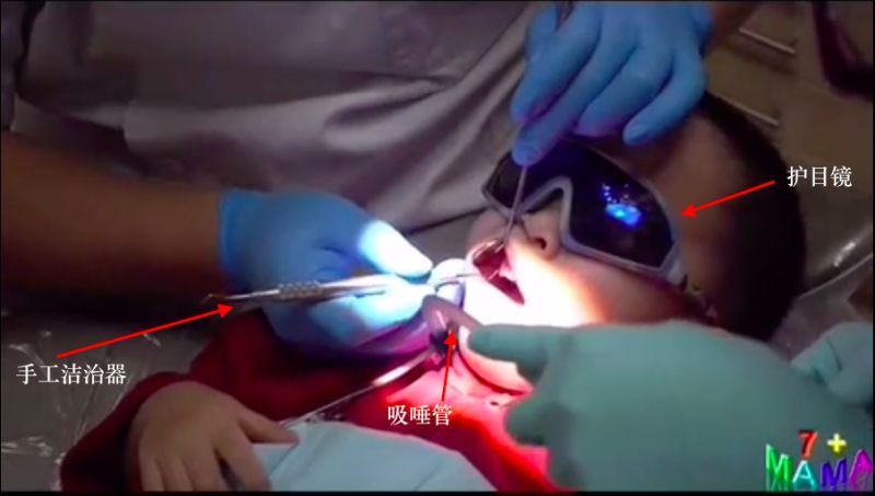 多图直击！牙医如何用抛光把孩子的牙洗干净？#葉子口腔科普#