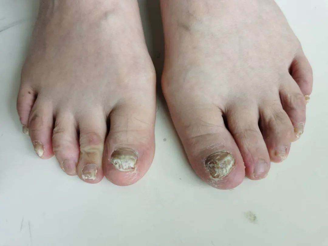 及时治疗脚气，是对家人最好的负责