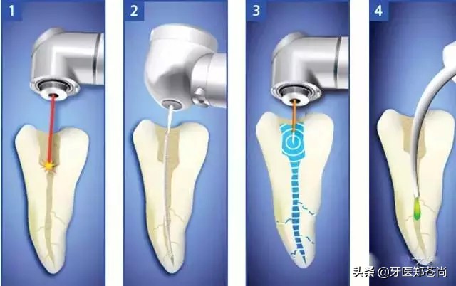 根管钙化不通还能做根管治疗吗,牙齿根管治疗1200跟900有什么区别