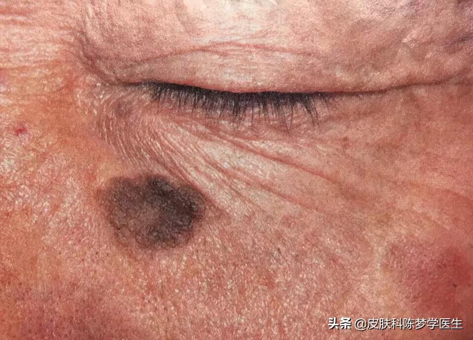 褐青斑是雀斑样痣吗,脸上太田痣怎么祛斑