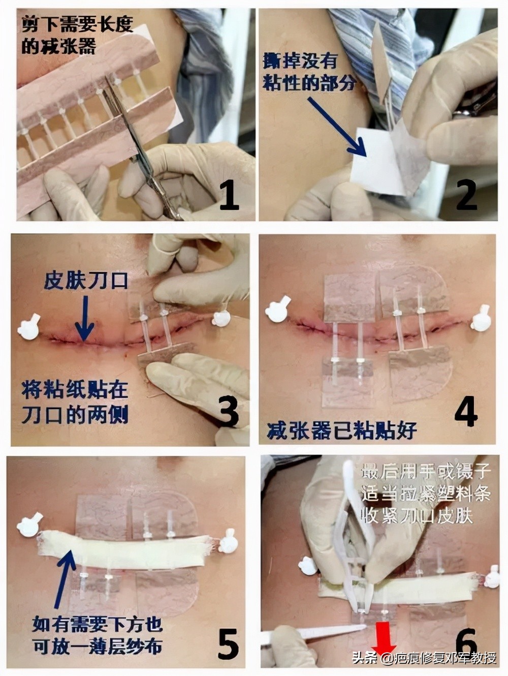 剖腹产疤痕增生特别痒怎么办,剖腹产疤痕增生凸起一条红肉