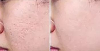 非剥落式点阵激光治疗痘坑,多浅的凹坑可以用点阵激光