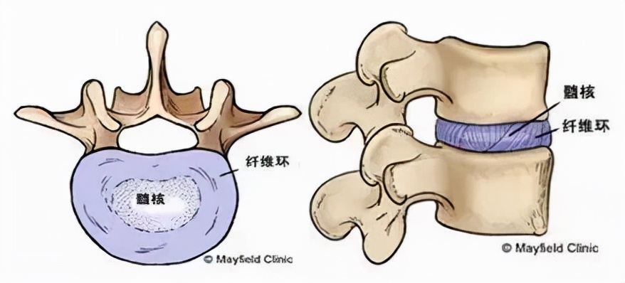 腰椎间盘突出保守治疗要绝对卧床吗,腰椎间盘突出保守治疗的最佳时间