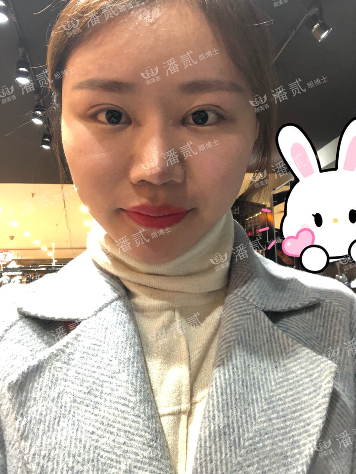 开眼角过大图片,开眼角过大修复效果图