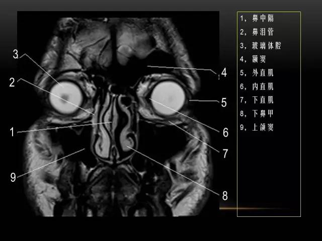 鼻腔鼻窦及颅底ct影像解剖,鼻窦解剖mri