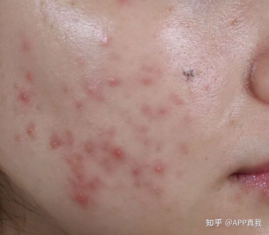 水杨酸棉片可以收缩毛孔吗,水杨酸真的可以收缩毛孔吗