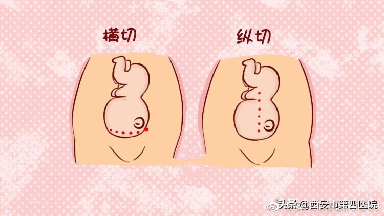 剖宫产的孩子和顺产的孩子的区别,一胎剖宫产二胎顺产的几率有多大