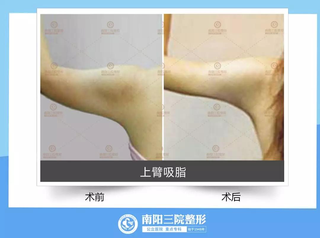 吸脂手术一秒变瘦,做了吸脂手术再减肥还能瘦么