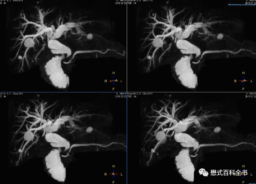 开展mrcp技术,mrcp检查操作流程
