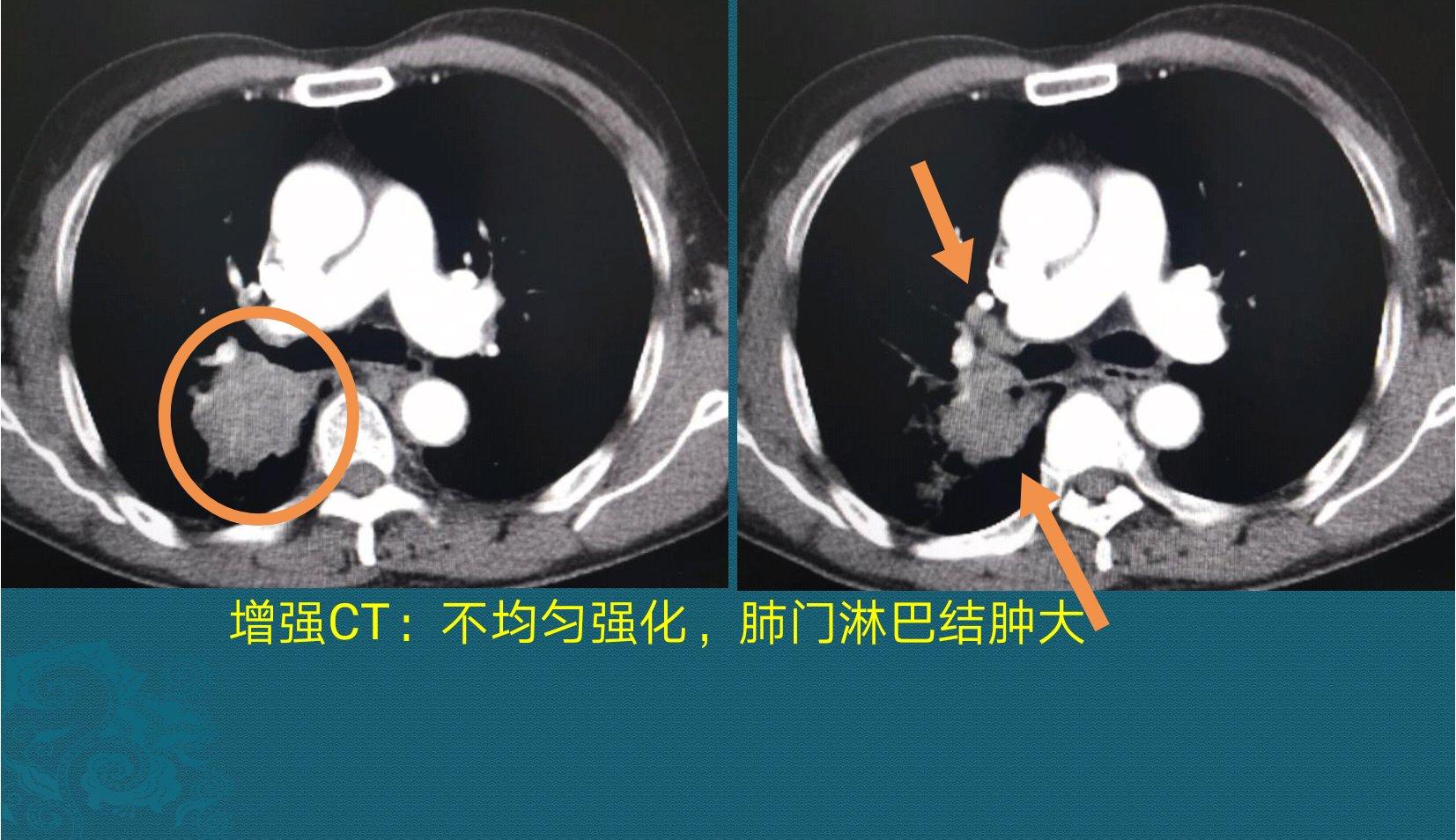 肺癌照ct能查出癌症吗,早期肺癌做癌症筛查能查出吗
