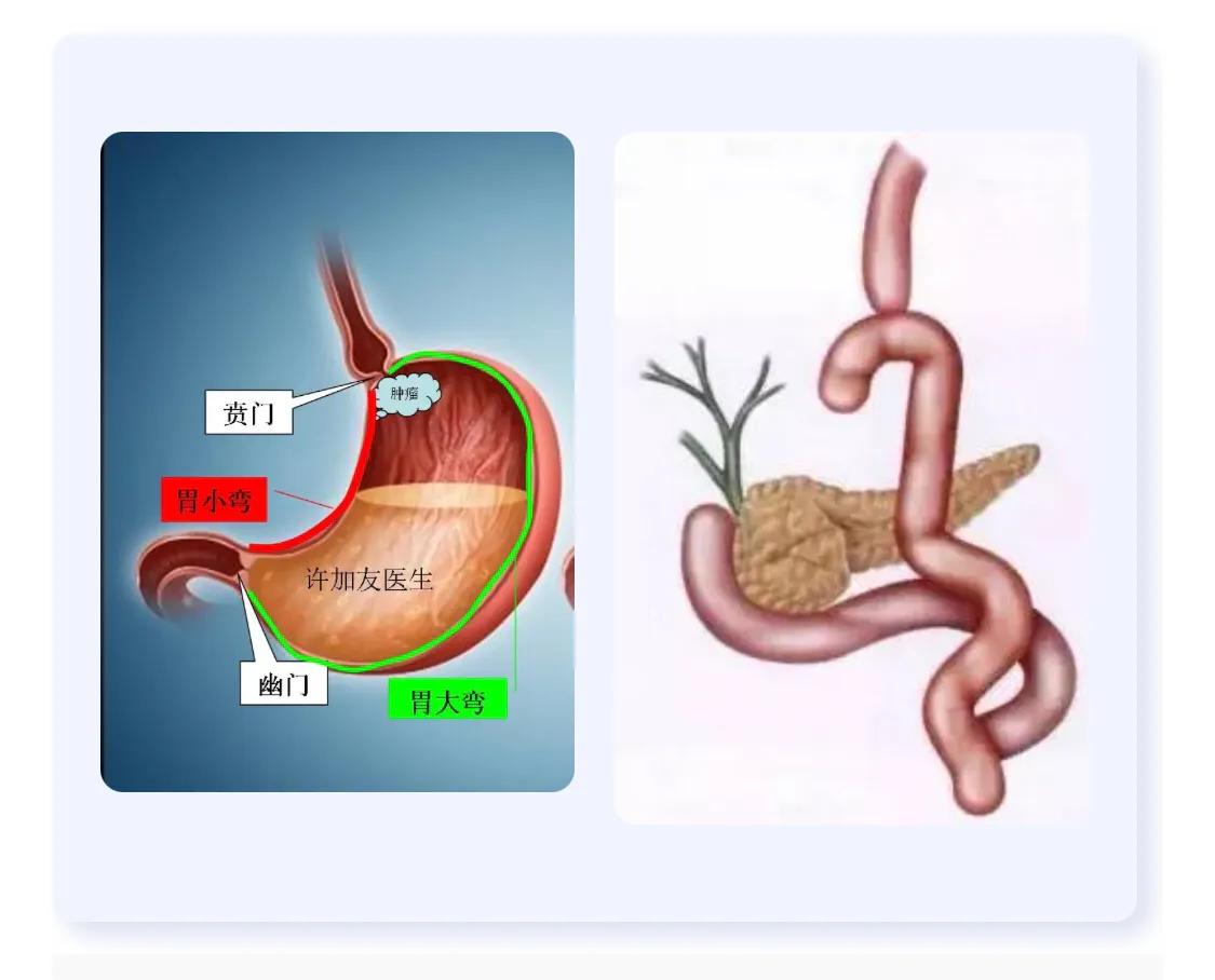 把胃切了怎么消化,把胃都切了会怎么样