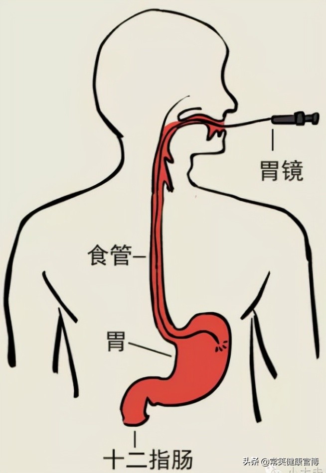无痛胃镜和普通胃镜到底选择哪个,无痛胃镜和普通胃镜该怎么选