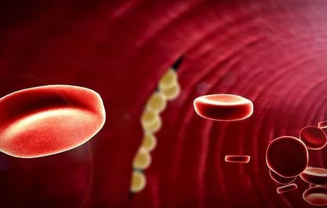 面对一个患有脑梗的怎么去安慰,中医耳道取栓治疗脑梗