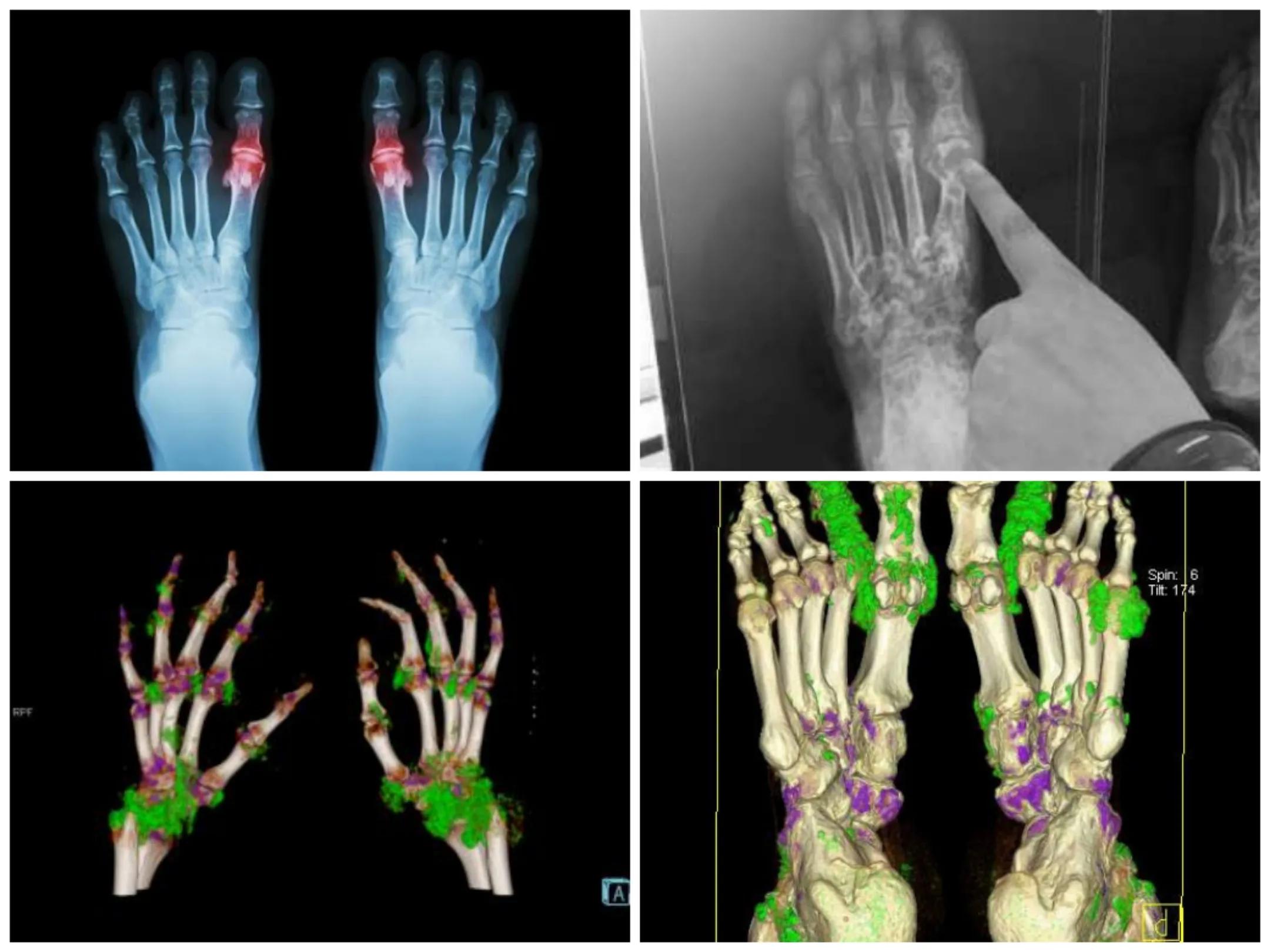 700尿酸属于什么等级,尿酸700多怎么调理