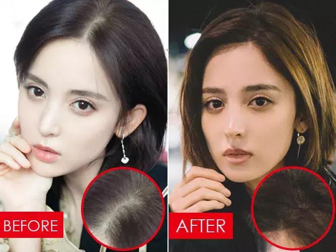 拯救发际线告别大额头,拯救发际线不走冤枉路