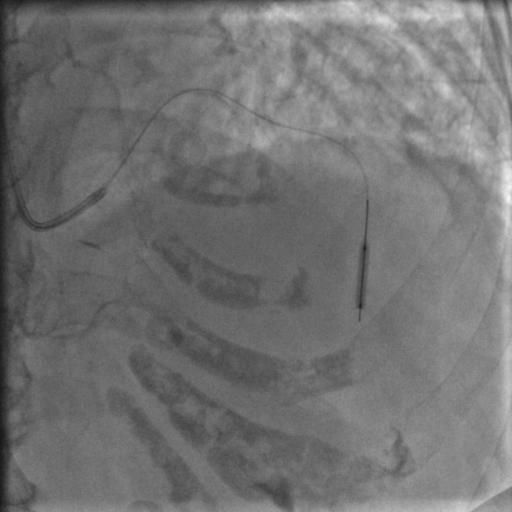 85岁老人心脏堵塞,77岁老人冠脉狭窄放支架还是搭桥