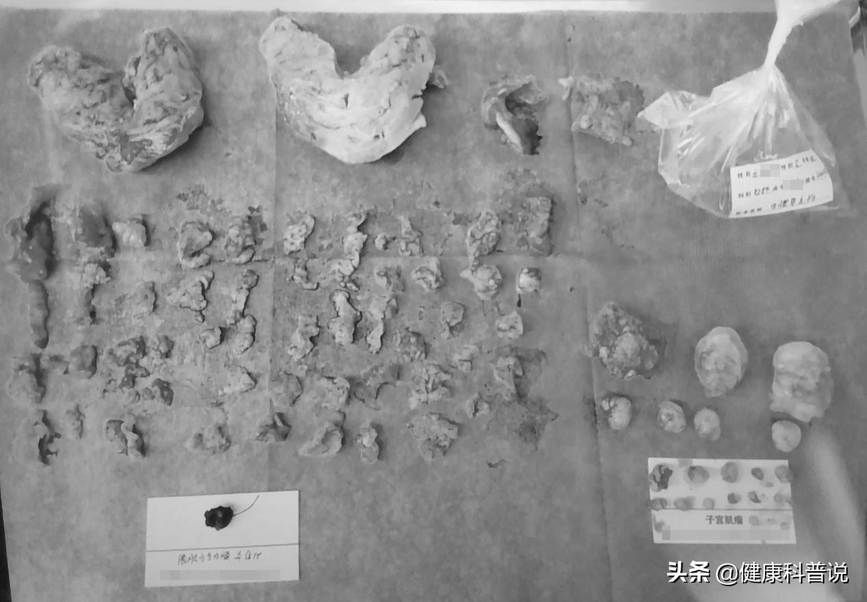 腺肌症保宫手术让你和痛经说再见,子宫腺肌症痛经死去活来