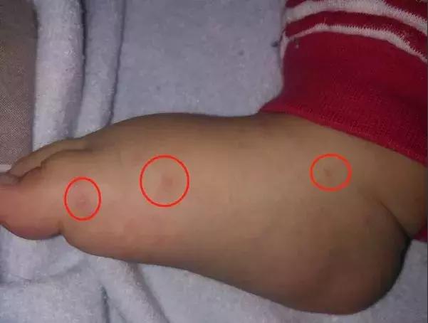 手足口喝利巴韦林管用吗,利巴韦林可以治手足口吗