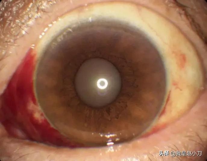 肺炎能通过眼睛传播吗？家里能用紫外灯消毒吗？