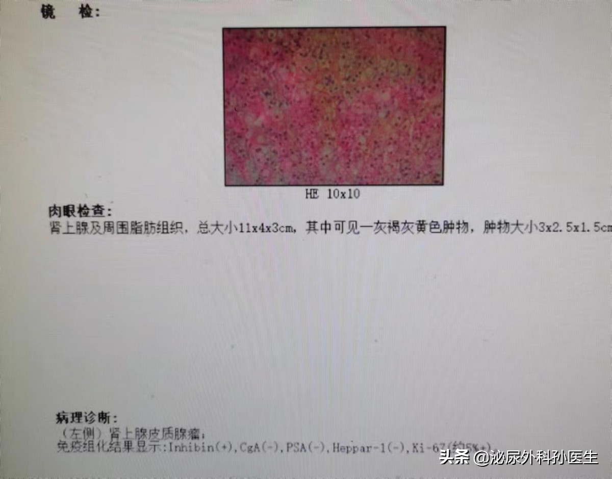 前列腺不典型小腺泡增生是癌症吗,前列腺增生血尿会是癌症吗