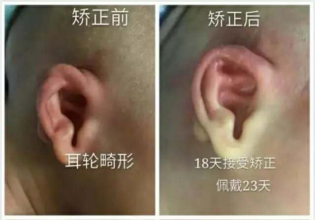 耳廓畸形高考生体检怎么办,二度耳廓畸形矫正方案