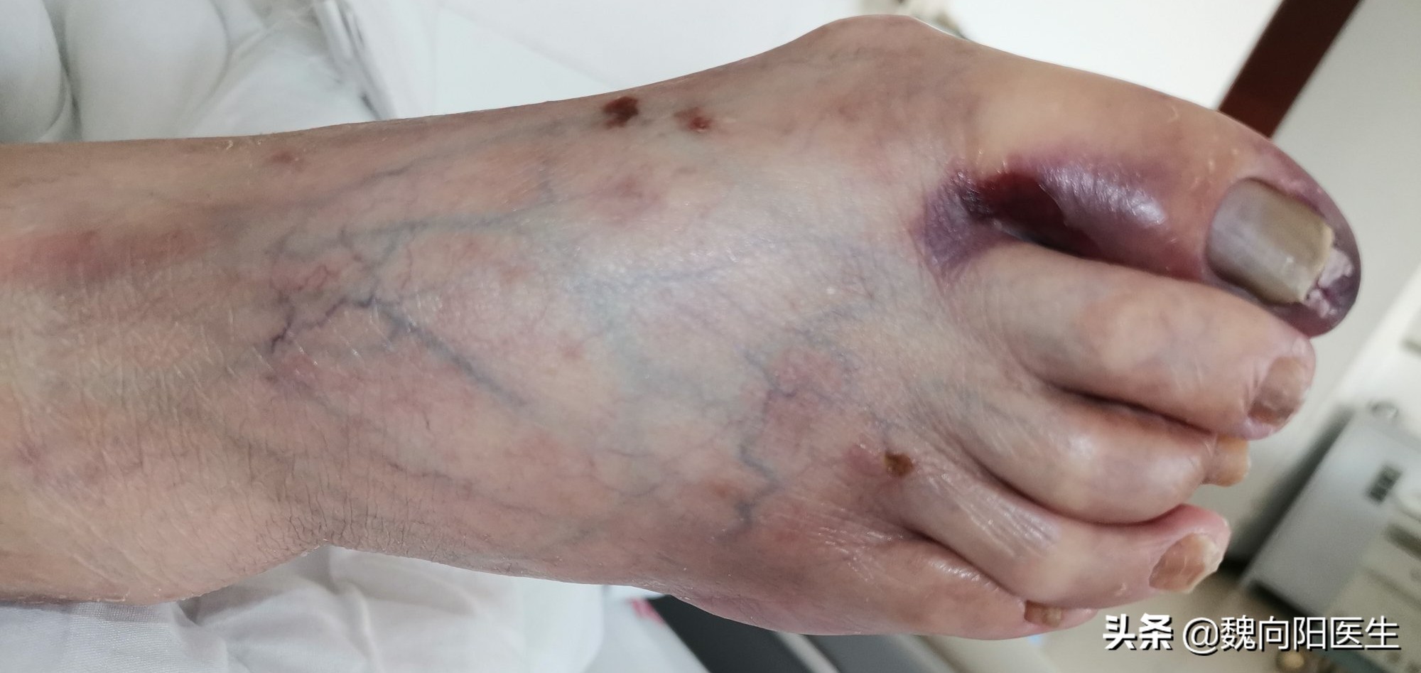 脚趾是平的是糖尿病足么,糖尿病足脚趾甲会什么样