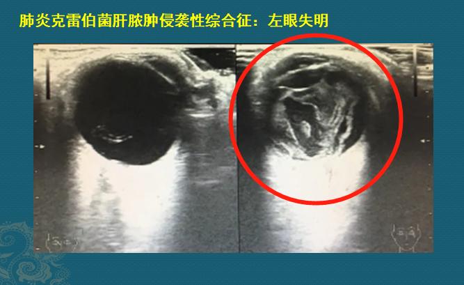 糖尿病人不要犟，有1种细菌喜欢喝糖浆，感染眼睛会失明