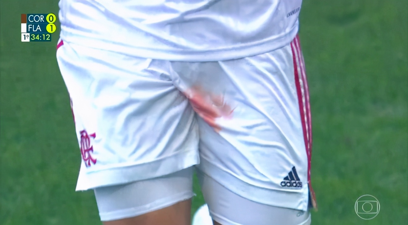 “蛋蛋”的忧伤!巴西后卫关键部位被铲伤,血染球裤仍想坚持比赛