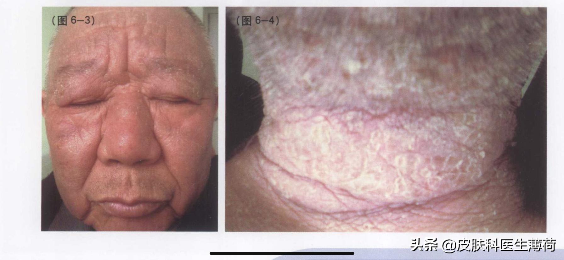 如何防止光老化氧化,预防光老化的最佳方法