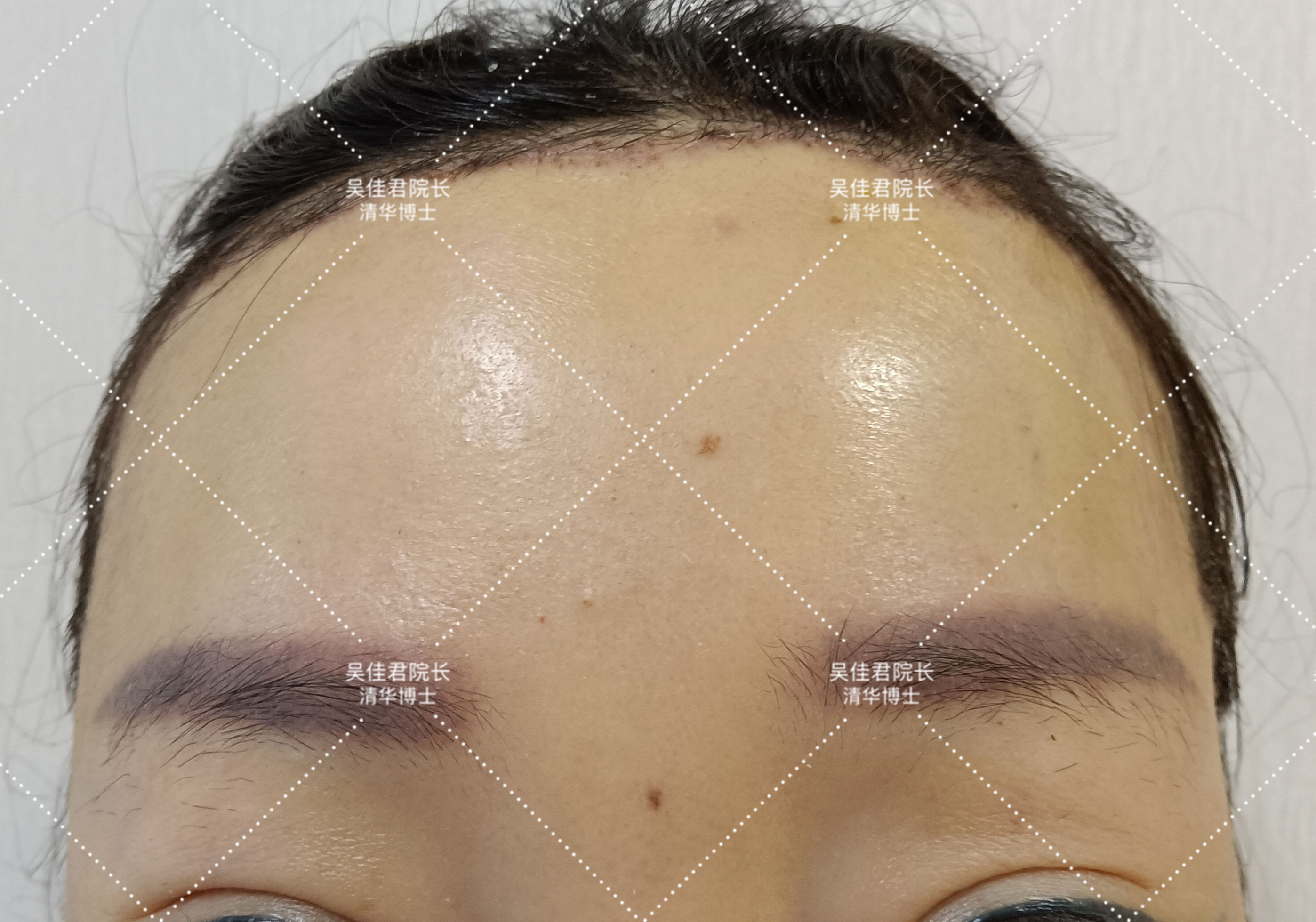 小切口拉皮除皱术适合额头除皱吗,额头缩小大拉皮手术恢复过程