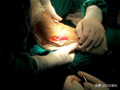 陈旧性踝关节损伤的治疗,踝关节损伤现场处理视频