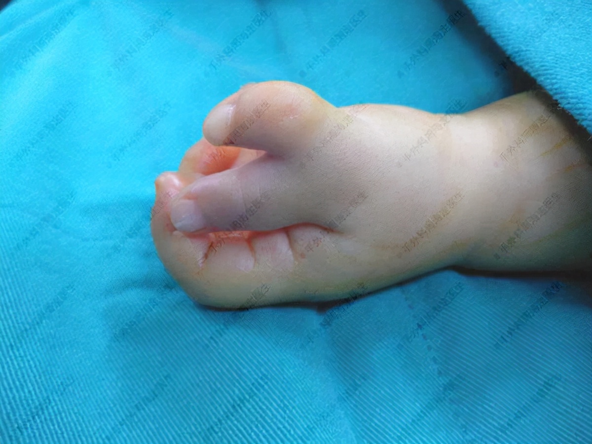 手多指同时脚也多指的婴幼儿多吗,婴儿多指并指多大手术最好
