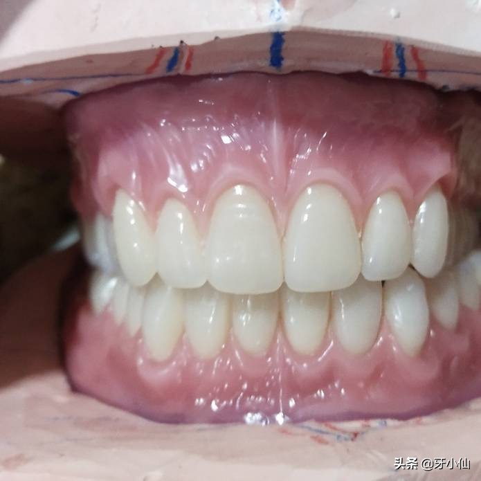 老人牙掉了种牙好还是镶牙好,老人半口牙都掉了做什么牙合适