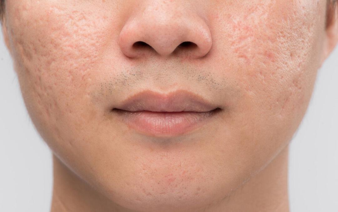 为什么长痘痘一直反反复复,反复长痘痘这5个坑别再踩了