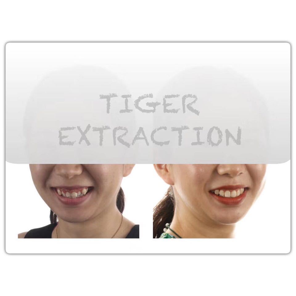 南京成人隐形牙齿矫正一般多少钱,隐适美牙齿矫正比较好的医院