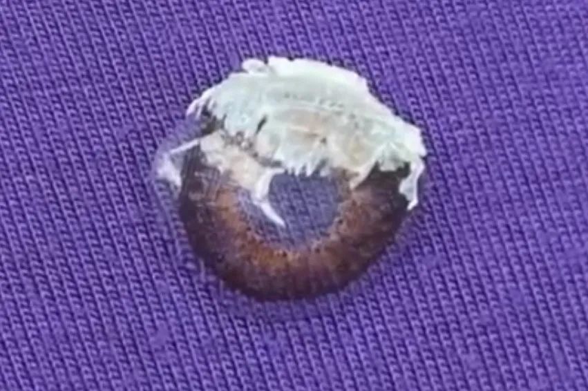 误把502胶水当作眼药水滴眼,502胶水怎么当眼药水