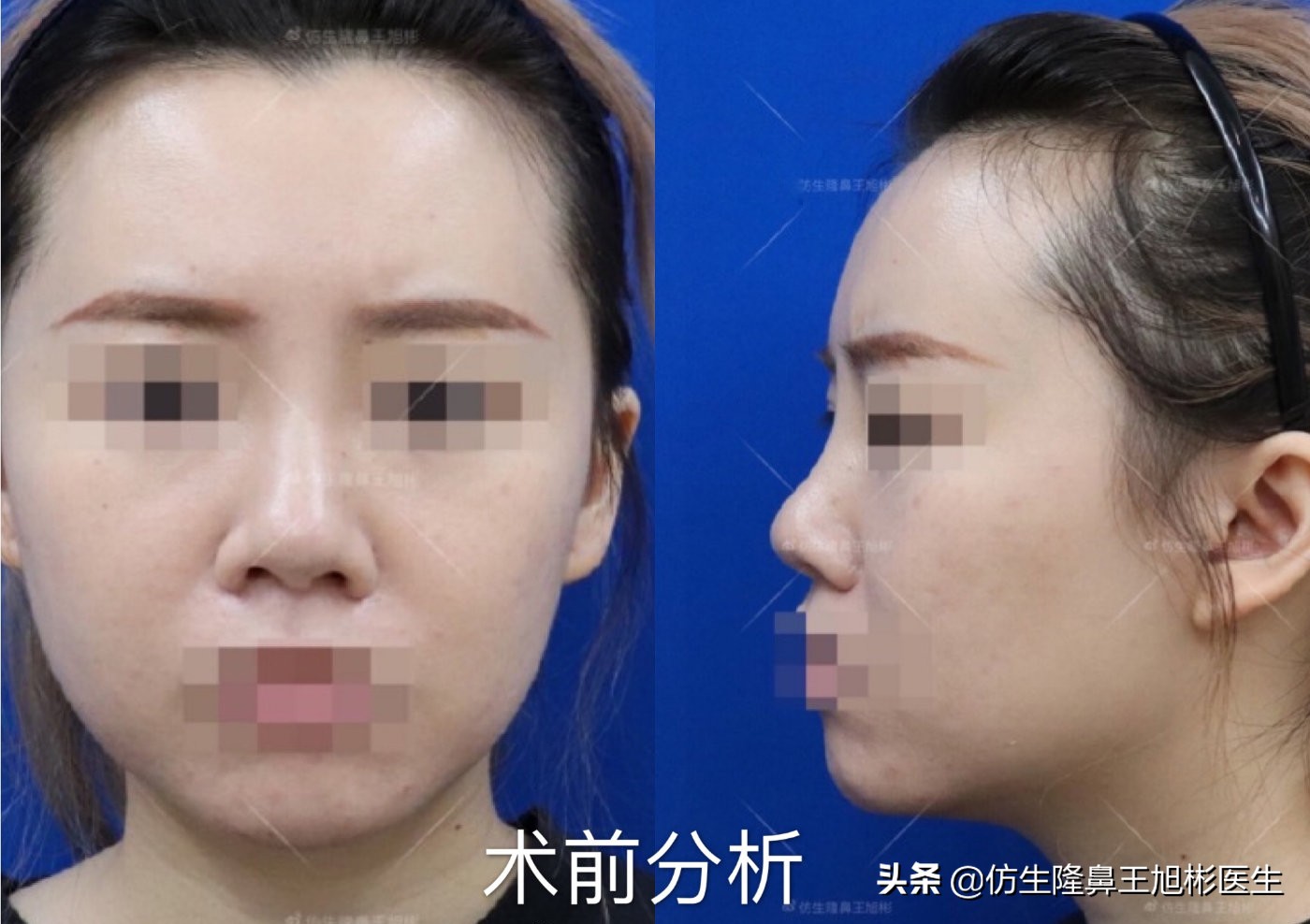 短鼻延长,短鼻塌鼻可以逆袭变长吗