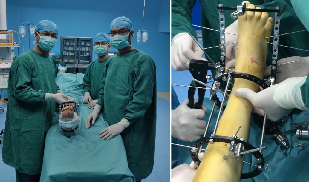 ilizarov技术演示,ilizarov技术手术步骤