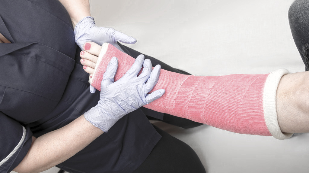 打石膏过程中怎么运动最好,脚打石膏后多久可以正常走路