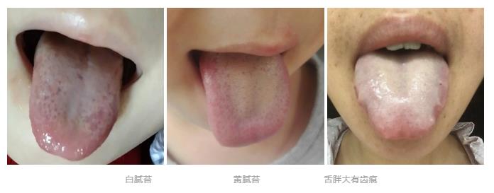 孩子湿气重不重就看这三点,孩子湿气重不重