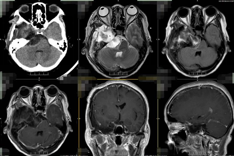查出恶性肿瘤做手术能好吗,良性脑肿瘤手术费用