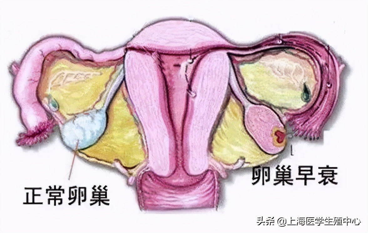 试管婴儿取完卵防止腹水,试管婴儿取完卵后注意哪些事项