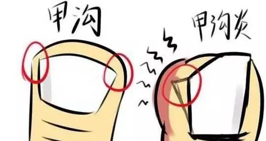 儿童怎么预防甲沟炎,美甲能预防甲沟炎吗