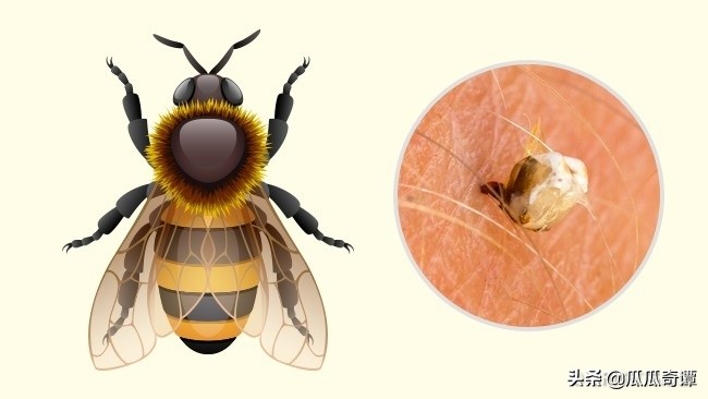 夏季蚊虫叮咬教你一招轻松解决,各种昆虫叮咬清晰图片对照表