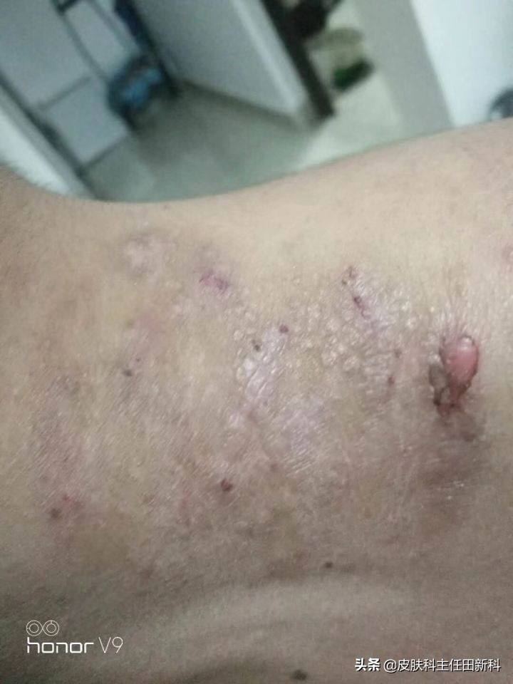 真菌感染性皮肤病原因,人真菌皮肤病怎么治