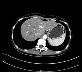 从胃炎到胃癌需要四步,从胃炎到胃癌往往出现这4个迹象