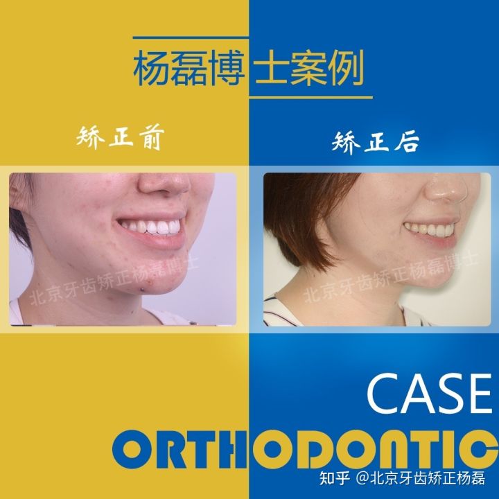 北京牙齿矫正大约要多少钱,北京哪个医院看牙齿矫正比较好