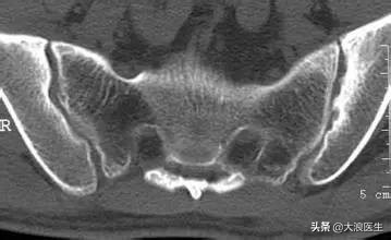 腰椎膨出和强直性脊柱炎的区别,腰间盘突出和强直性脊柱炎的区别