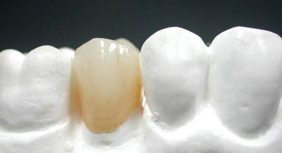 全瓷牙和烤瓷牙有什么区别哪个好,到底是烤瓷牙好还是全瓷牙好呢